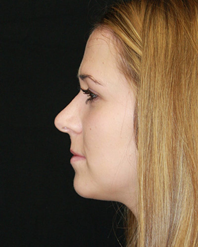 Rhinoplasty Before & After Gallery - Patient 143521961 - Image 4