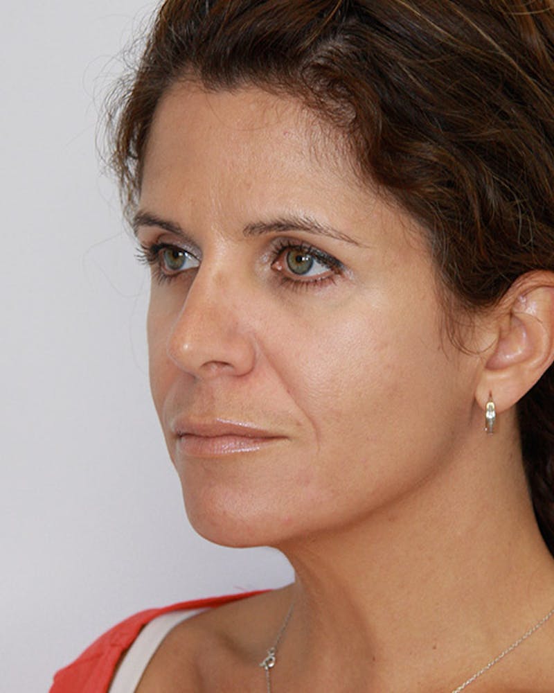 Revision Rhinoplasty Before & After Gallery - Patient 143521960 - Image 6