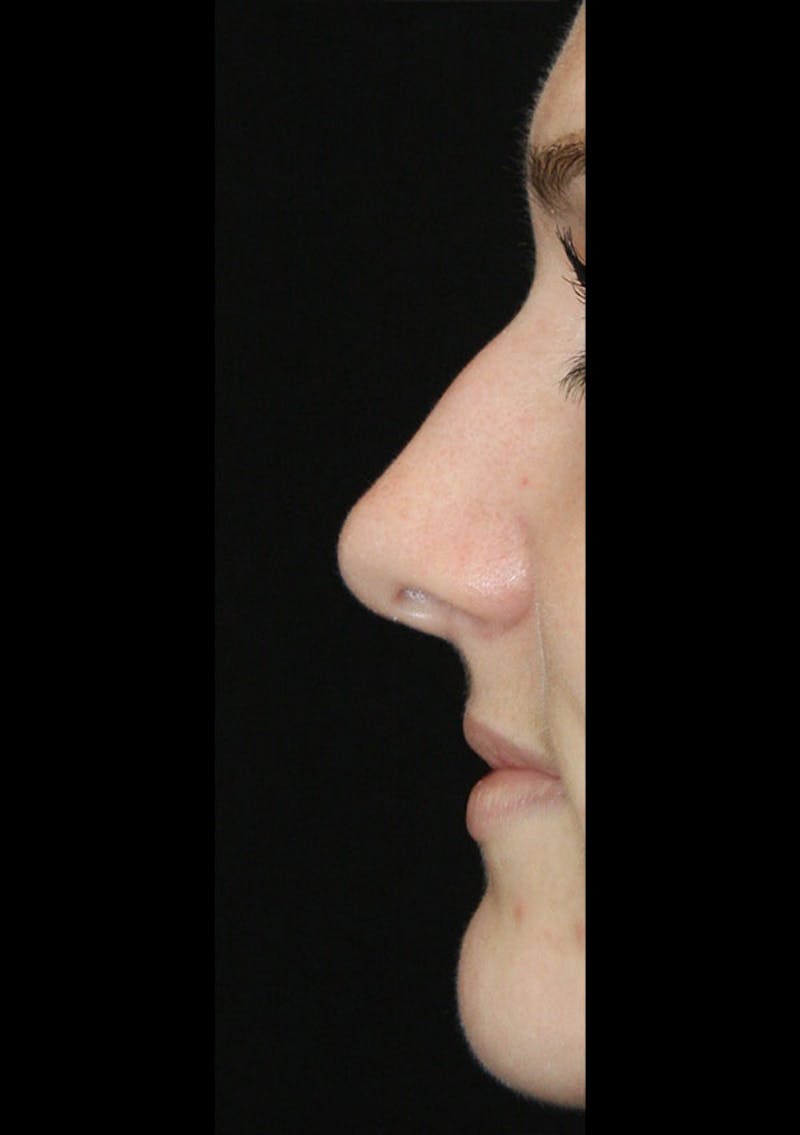 Non-Surgical Rhinoplasty Before & After Gallery - Patient 143521958 - Image 3