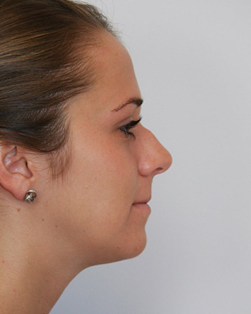 Rhinoplasty Before & After Gallery - Patient 143521961 - Image 5