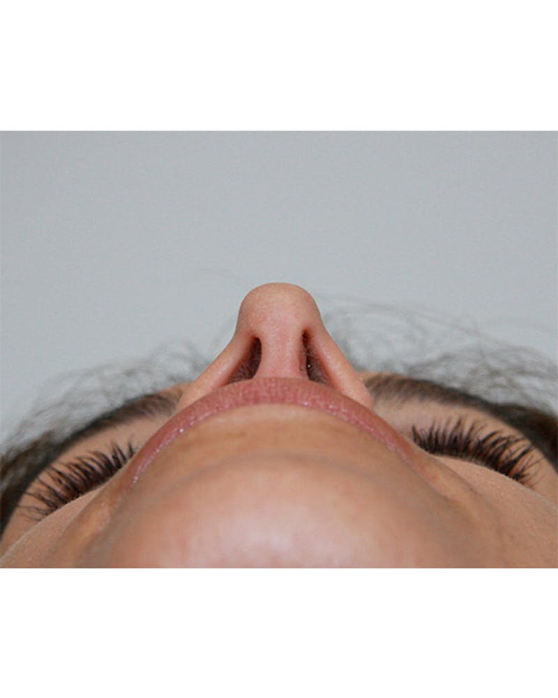 Revision Rhinoplasty Before & After Gallery - Patient 143521960 - Image 7