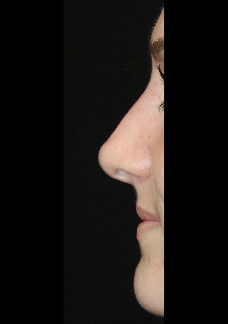 Non-Surgical Rhinoplasty Before & After Gallery - Patient 143521958 - Image 4