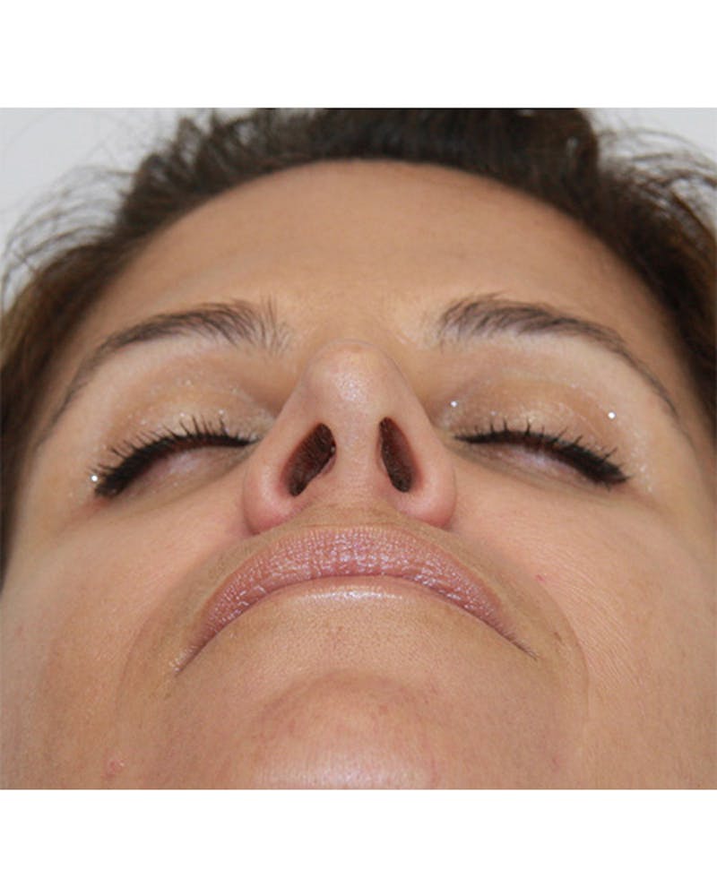 Revision Rhinoplasty Before & After Gallery - Patient 143521960 - Image 8