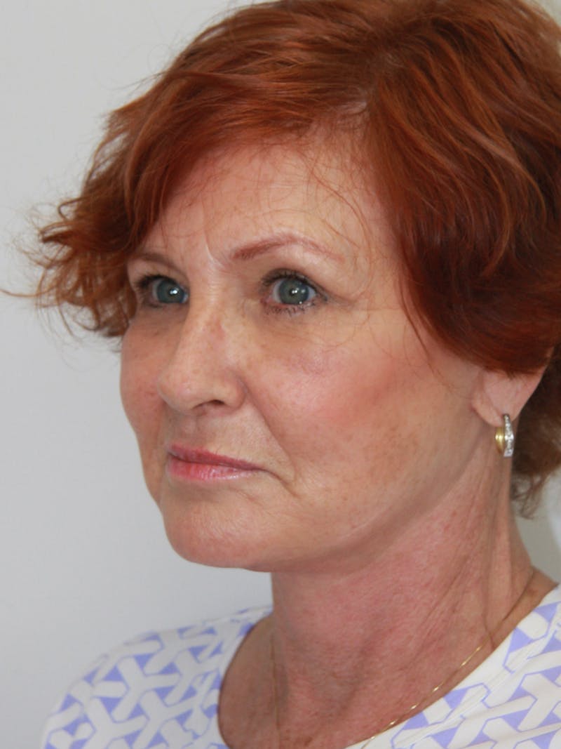 Facelift & Neck Lift Before & After Gallery - Patient 143521965 - Image 4