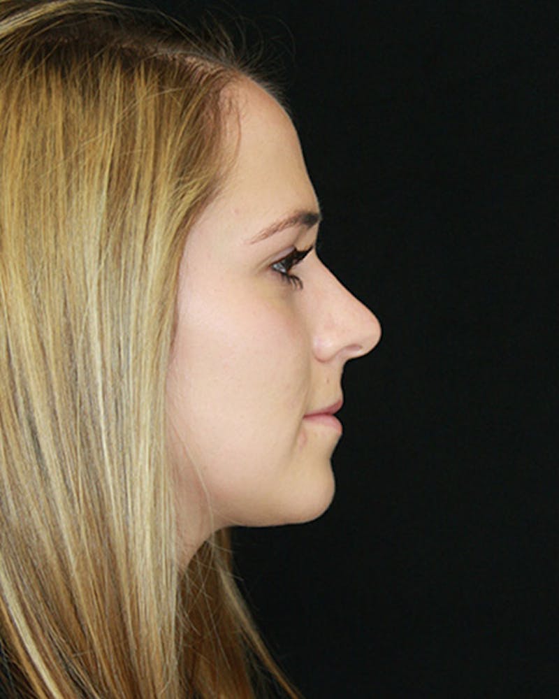 Rhinoplasty Before & After Gallery - Patient 143521961 - Image 6