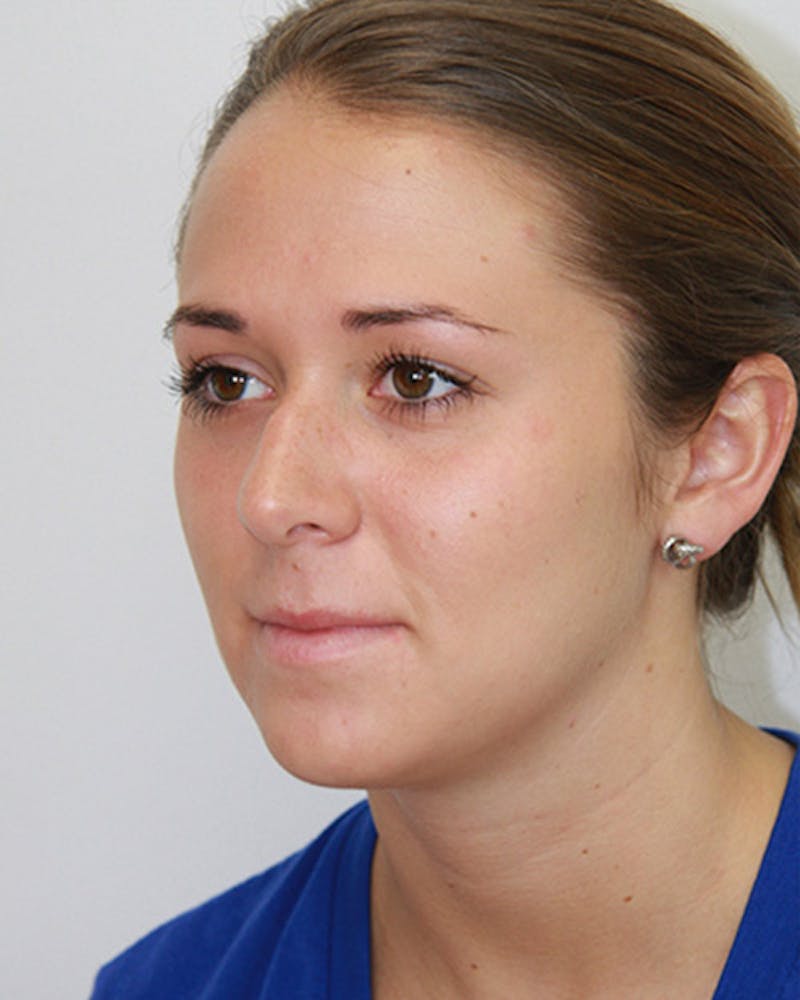 Rhinoplasty Before & After Gallery - Patient 143521961 - Image 7
