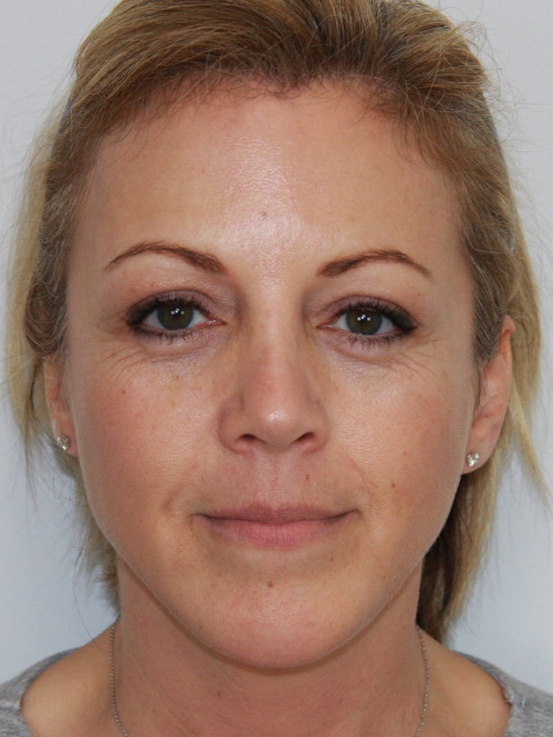 Eyelid Surgery Before & After Gallery - Patient 143521966 - Image 1