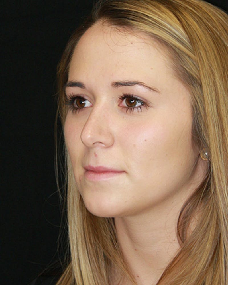 Rhinoplasty Before & After Gallery - Patient 143521961 - Image 8