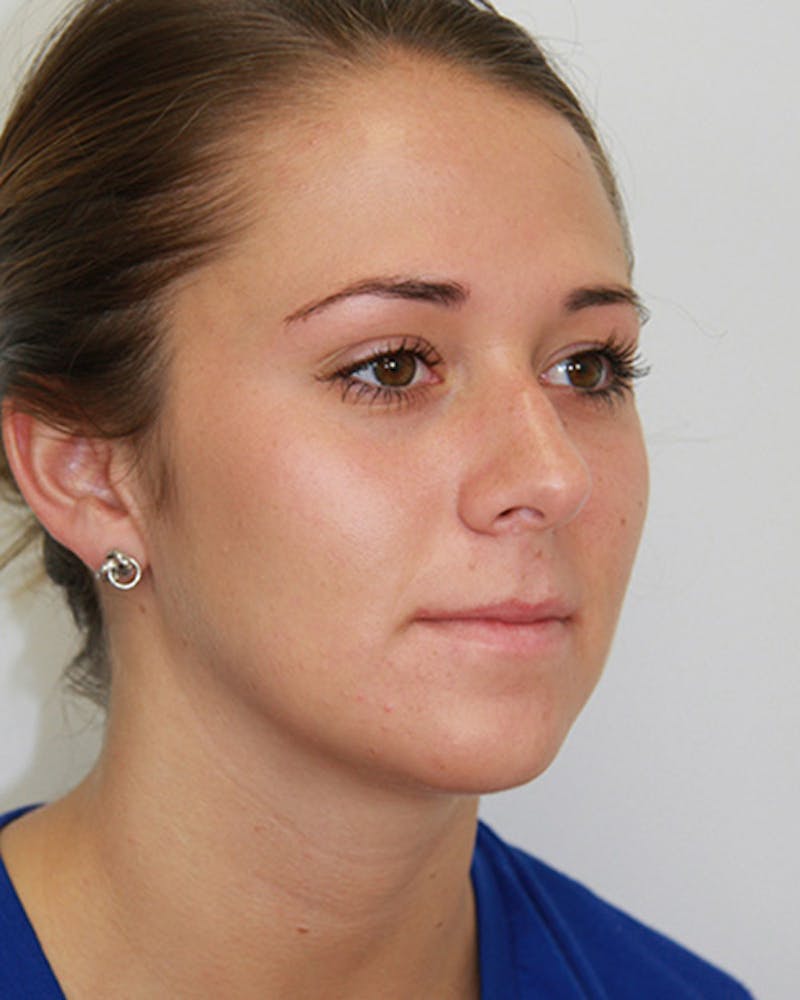 Rhinoplasty Before & After Gallery - Patient 143521961 - Image 9