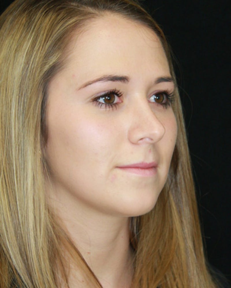 Rhinoplasty Before & After Gallery - Patient 143521961 - Image 10