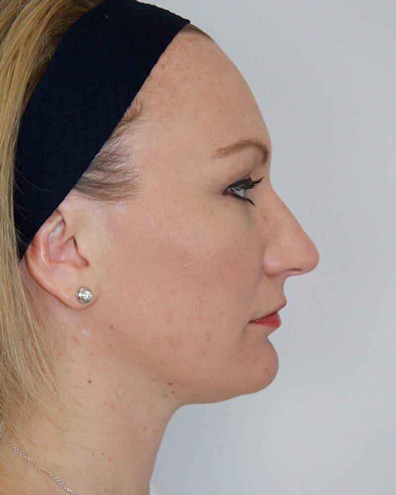 Rhinoplasty Before & After Gallery - Patient 143521963 - Image 1
