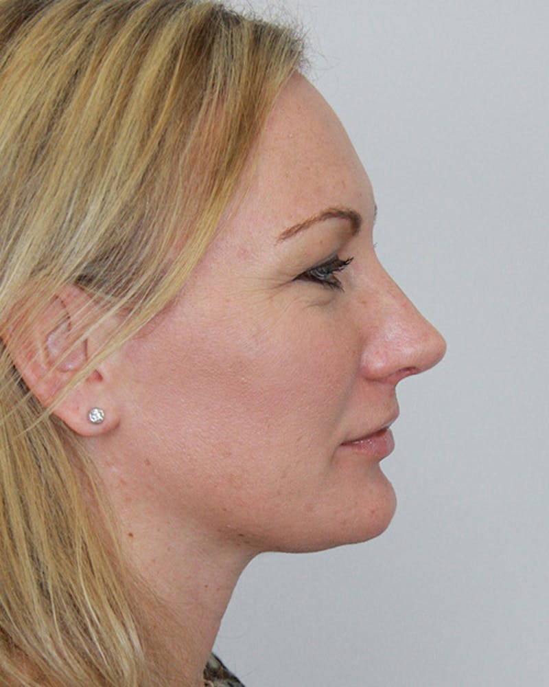 Rhinoplasty Before & After Gallery - Patient 143521963 - Image 2