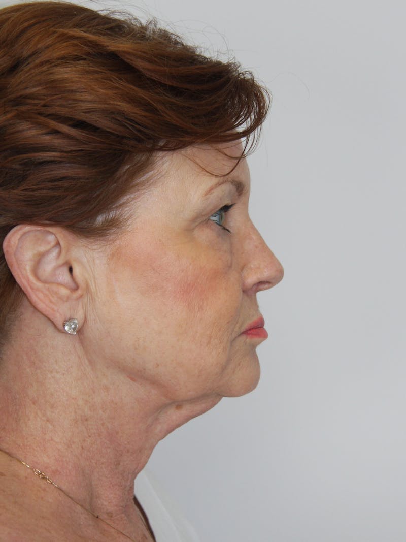 Facelift & Neck Lift Before & After Gallery - Patient 143521965 - Image 7