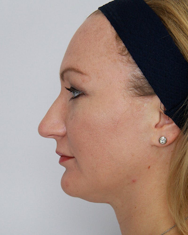 Rhinoplasty Before & After Gallery - Patient 143521963 - Image 3