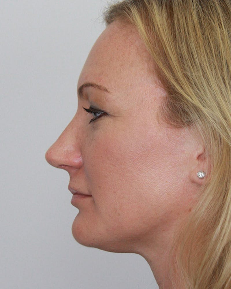 Rhinoplasty Before & After Gallery - Patient 143521963 - Image 4