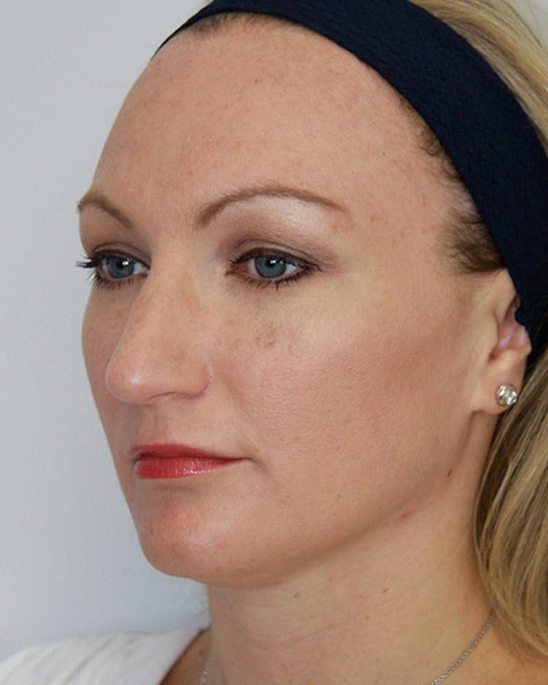 Rhinoplasty Before & After Gallery - Patient 143521963 - Image 5