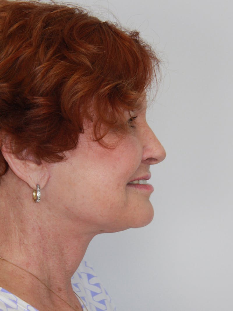 Facelift & Neck Lift Before & After Gallery - Patient 143521965 - Image 8
