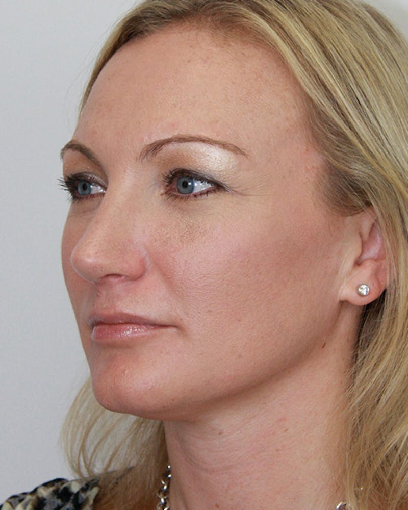 Rhinoplasty Before & After Gallery - Patient 143521963 - Image 6