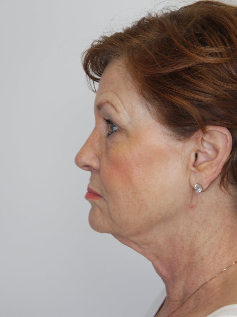 Facelift & Neck Lift Before & After Gallery - Patient 143521965 - Image 9