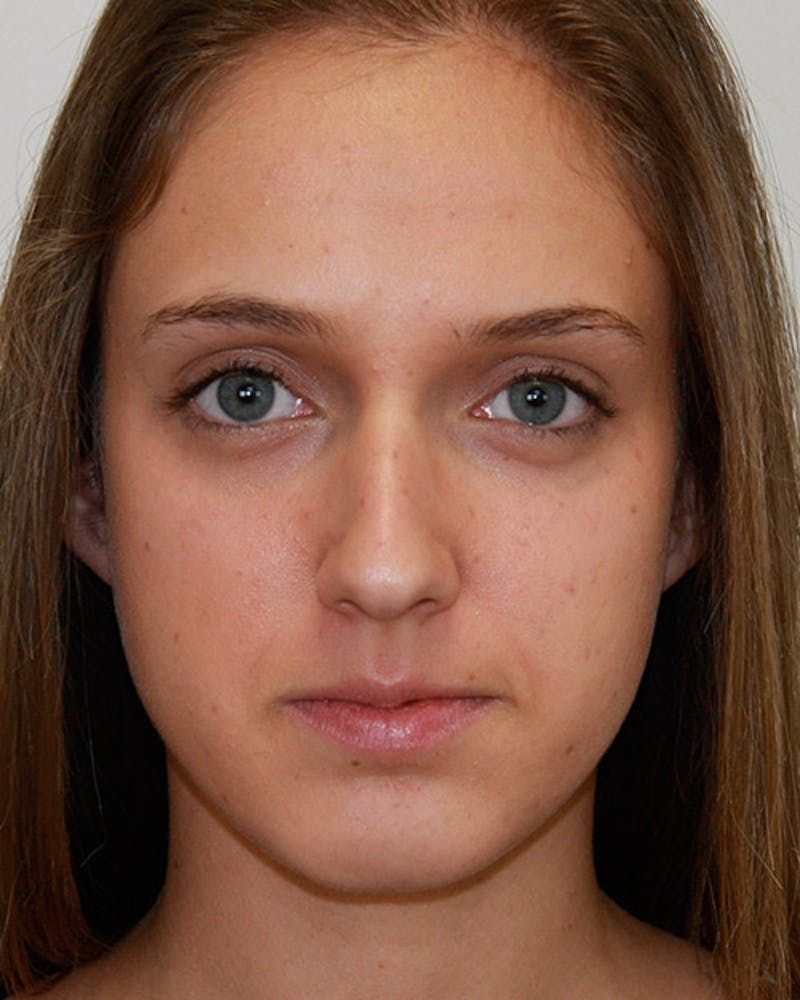 Rhinoplasty Before & After Gallery - Patient 143521967 - Image 1