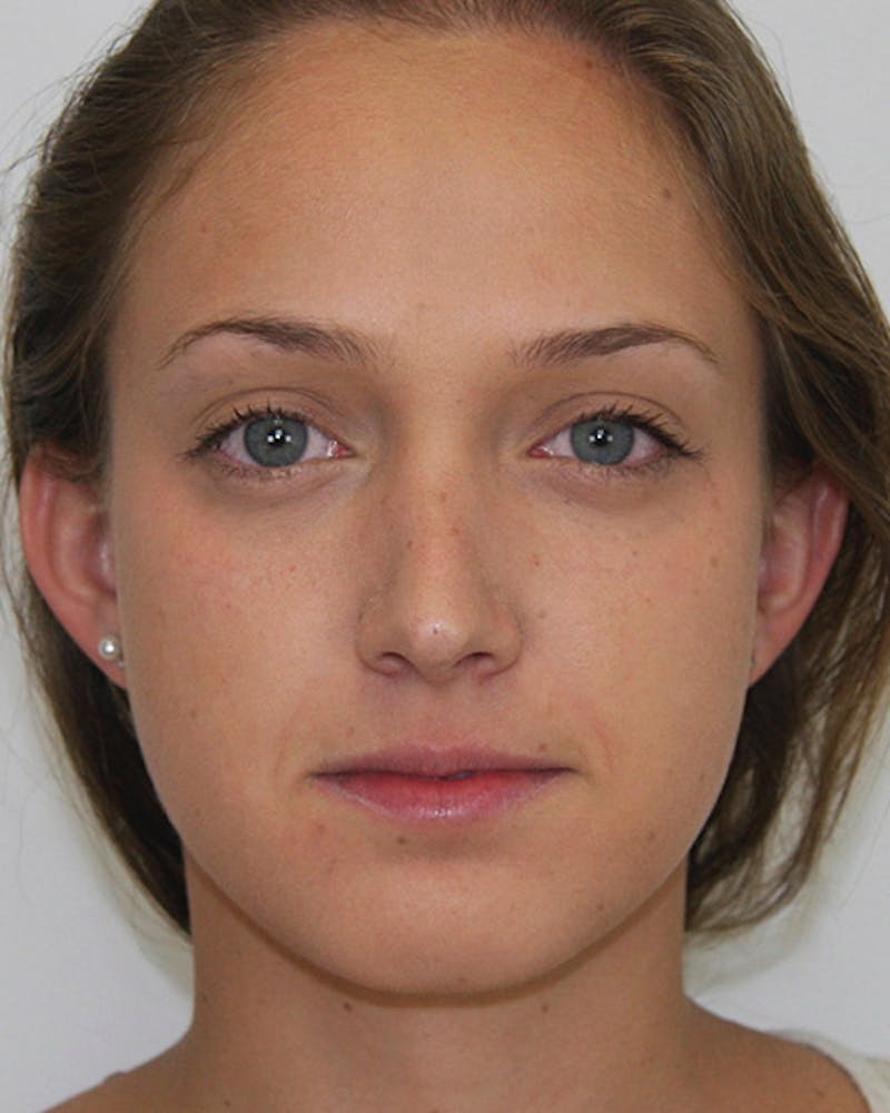 Rhinoplasty Before & After Gallery - Patient 143521967 - Image 2