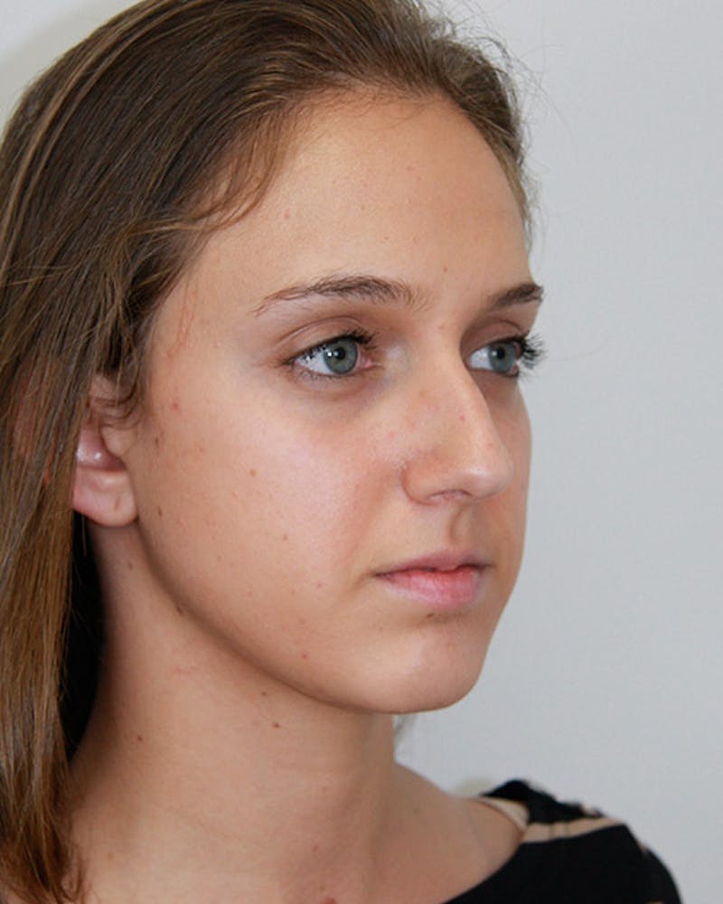 Rhinoplasty Before & After Gallery - Patient 143521967 - Image 3