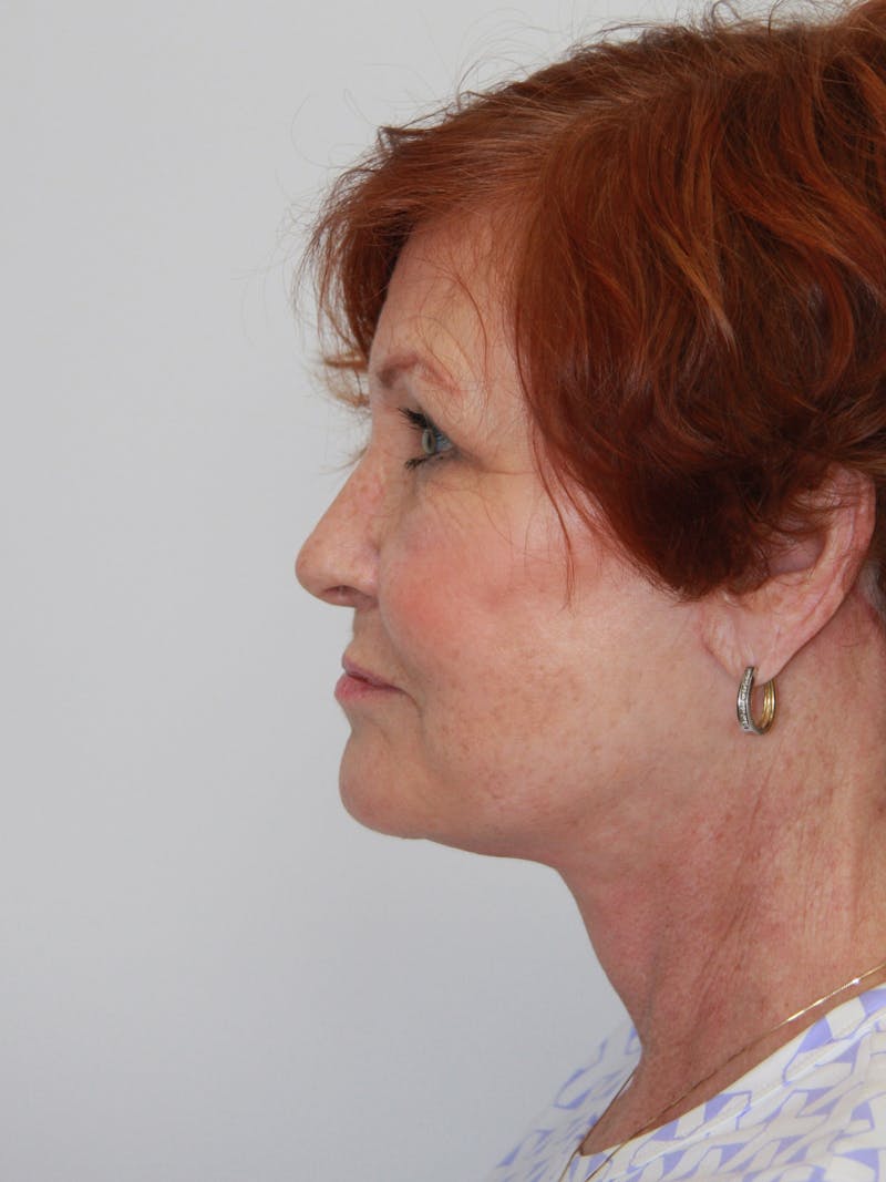 Facelift & Neck Lift Before & After Gallery - Patient 143521965 - Image 10