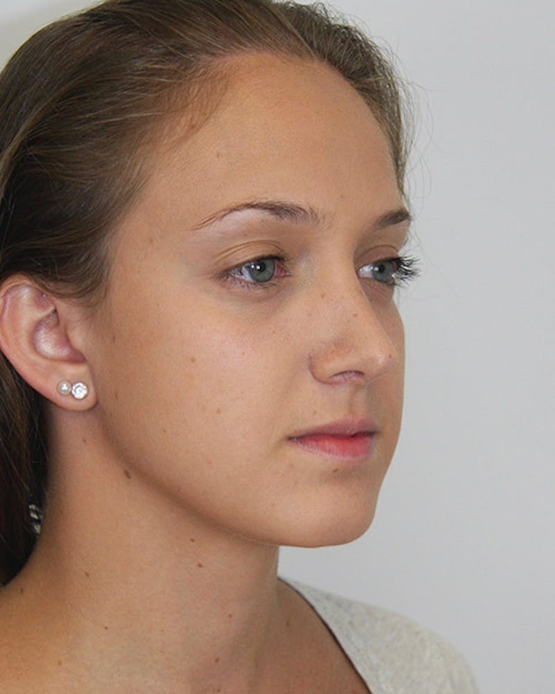 Rhinoplasty Before & After Gallery - Patient 143521967 - Image 4