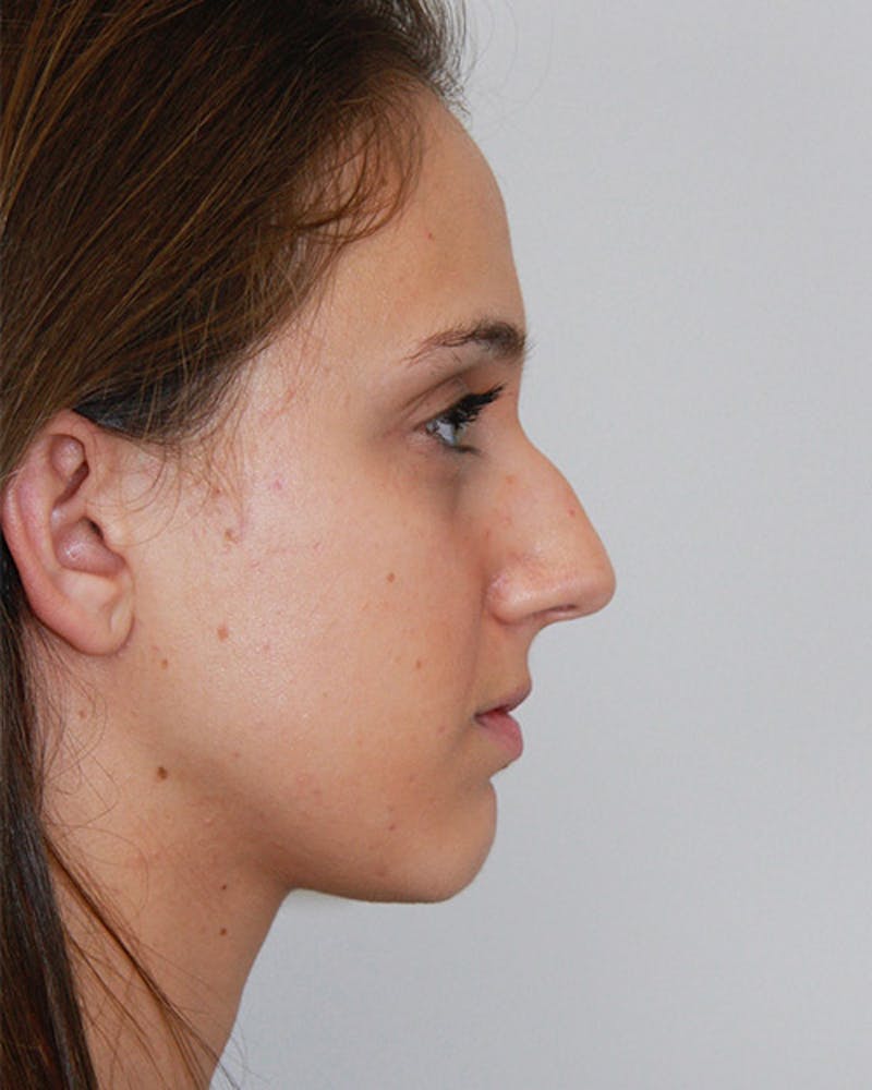 Rhinoplasty Before & After Gallery - Patient 143521967 - Image 5
