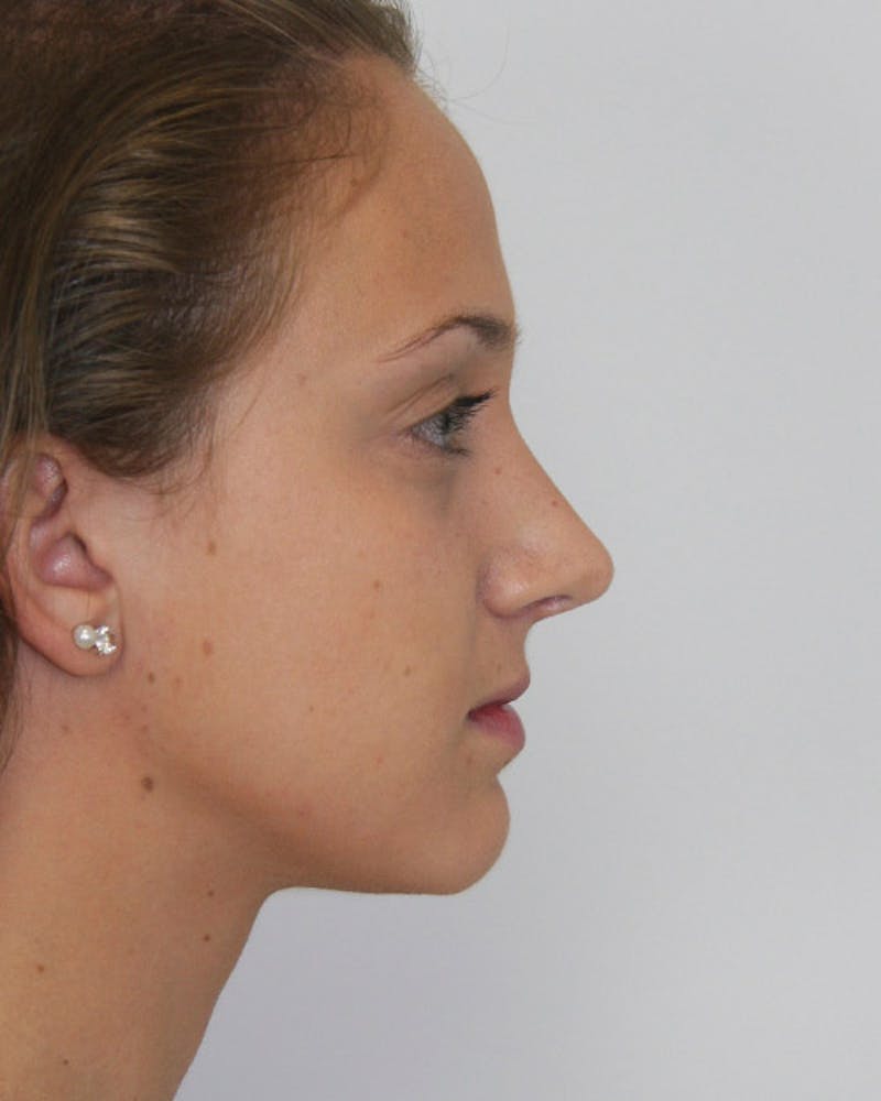 Rhinoplasty Before & After Gallery - Patient 143521967 - Image 6