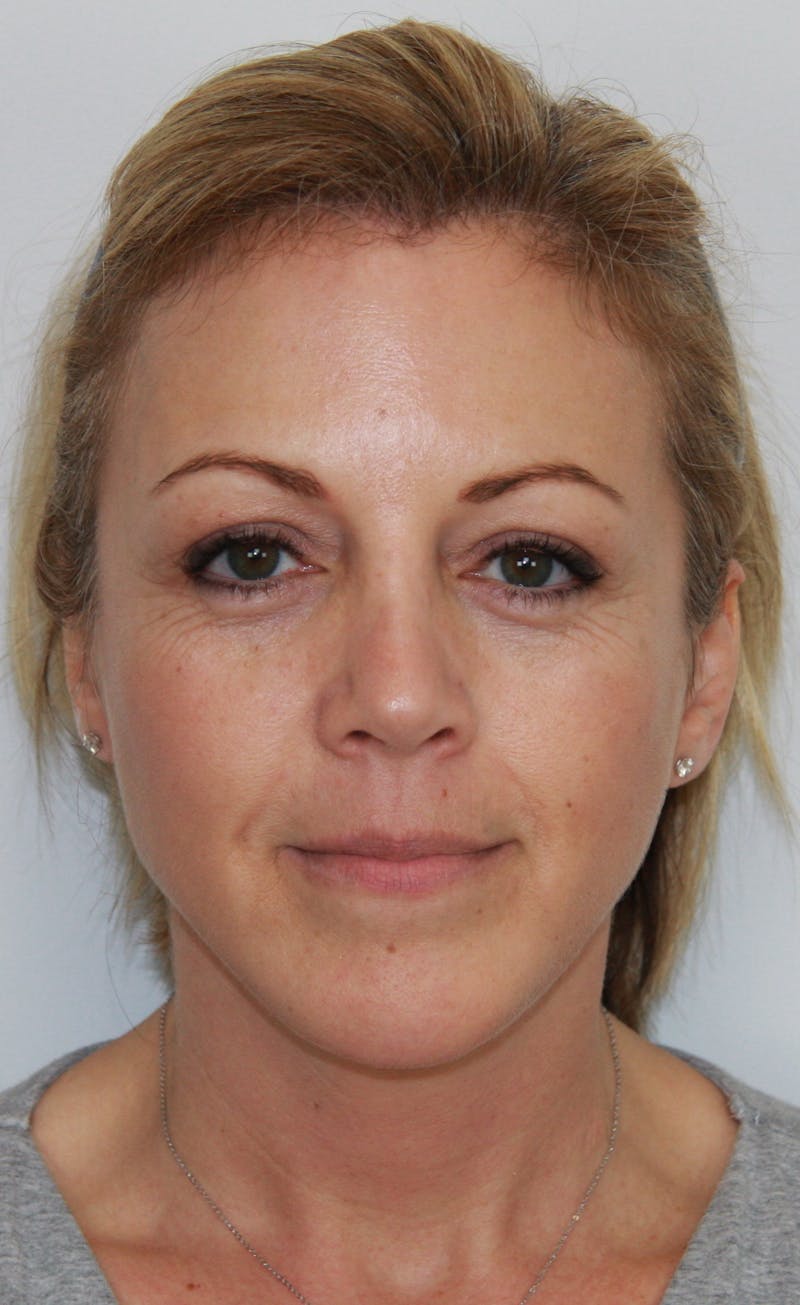 Facelift & Neck Lift Before & After Gallery - Patient 143521971 - Image 1