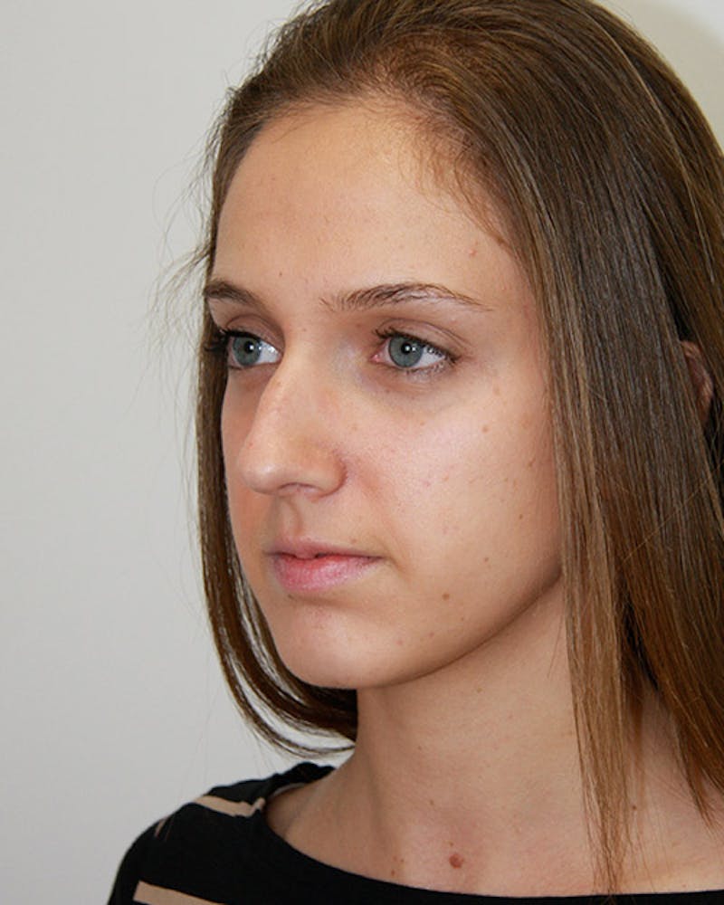 Rhinoplasty Before & After Gallery - Patient 143521967 - Image 7