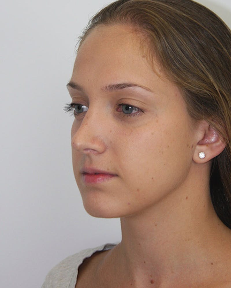 Rhinoplasty Before & After Gallery - Patient 143521967 - Image 8