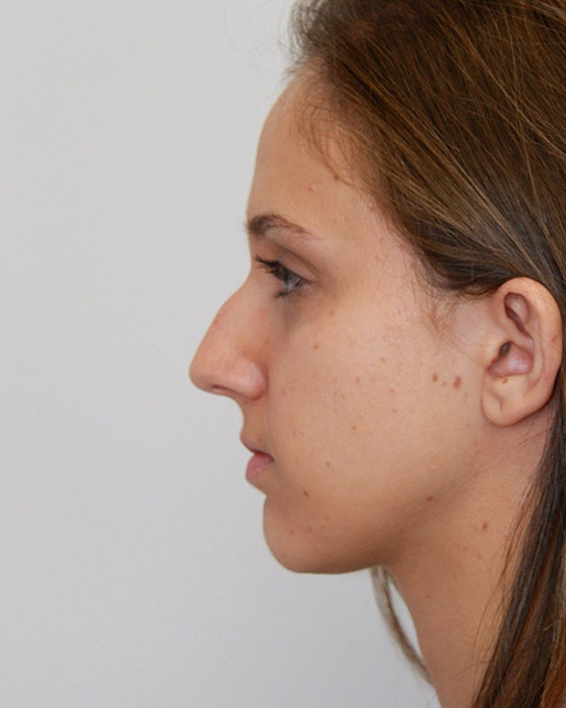 Rhinoplasty Before & After Gallery - Patient 143521967 - Image 9