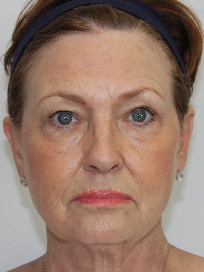 Eyelid Surgery Before & After Gallery - Patient 143521975 - Image 1