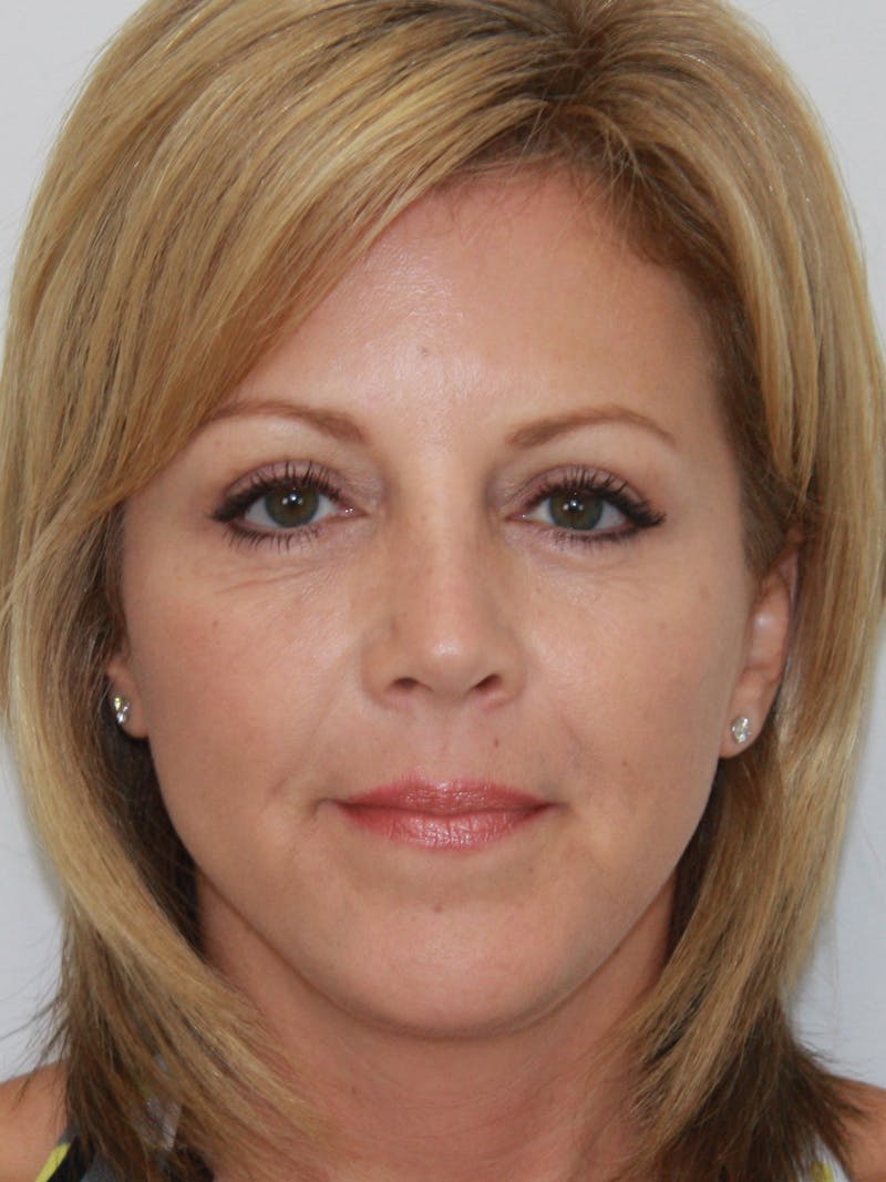 Facelift & Neck Lift Before & After Gallery - Patient 143521971 - Image 2