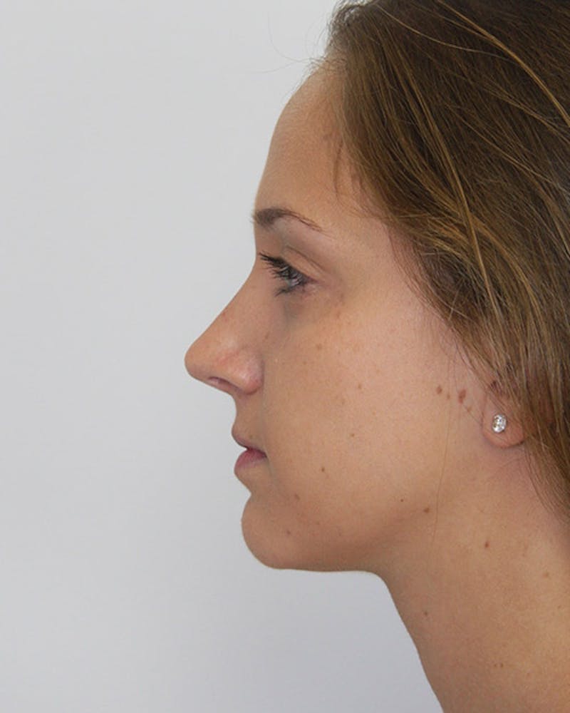 Rhinoplasty Before & After Gallery - Patient 143521967 - Image 10