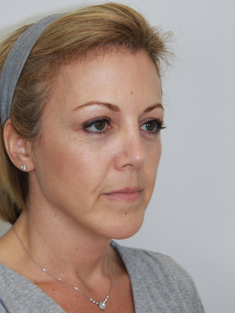Facelift & Neck Lift Before & After Gallery - Patient 143521971 - Image 3