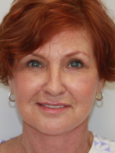 Eyelid Surgery Before & After Gallery - Patient 143521975 - Image 2