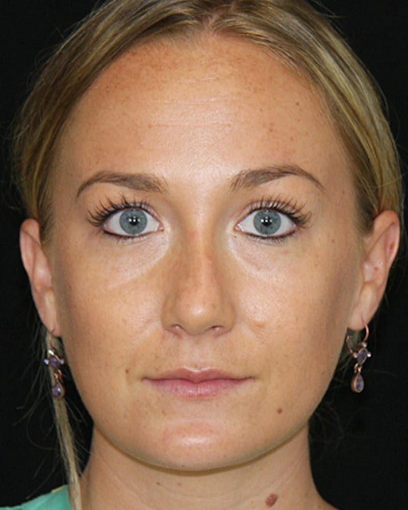 Rhinoplasty Before & After Gallery - Patient 143521970 - Image 1
