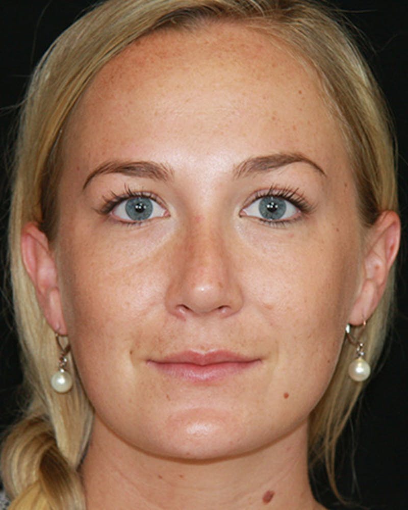 Rhinoplasty Before & After Gallery - Patient 143521970 - Image 2