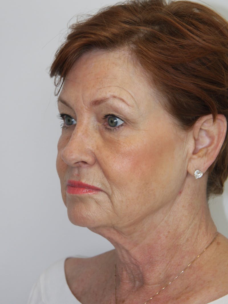 Eyelid Surgery Before & After Gallery - Patient 143521975 - Image 3