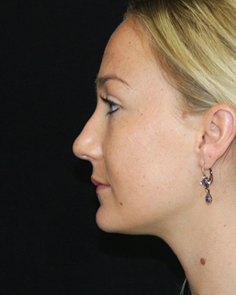Rhinoplasty Before & After Gallery - Patient 143521970 - Image 3