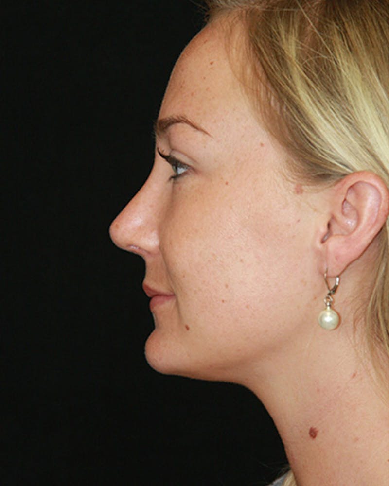 Rhinoplasty Before & After Gallery - Patient 143521970 - Image 4
