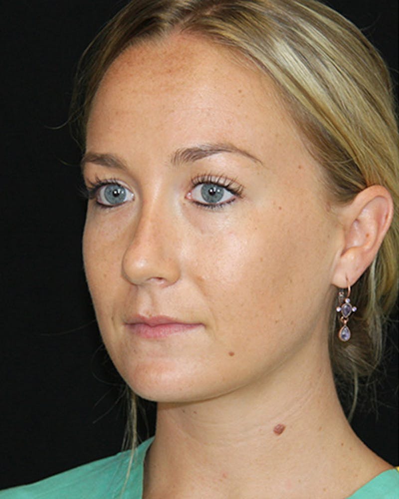 Rhinoplasty Before & After Gallery - Patient 143521970 - Image 5