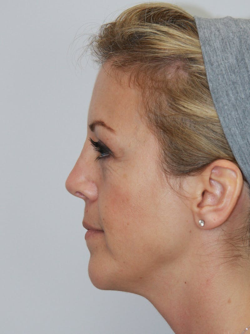 Facelift & Neck Lift Before & After Gallery - Patient 143521971 - Image 5