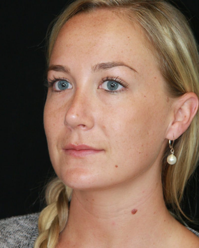 Rhinoplasty Before & After Gallery - Patient 143521970 - Image 6