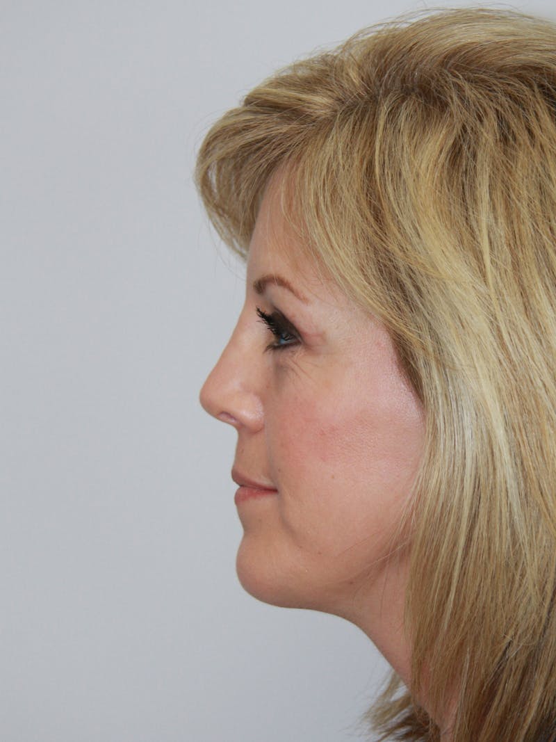 Facelift & Neck Lift Before & After Gallery - Patient 143521971 - Image 6