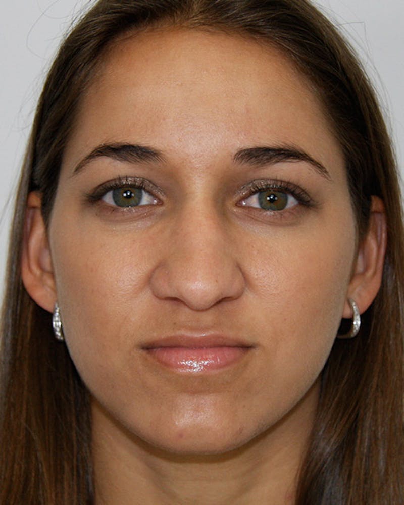 Rhinoplasty Before & After Gallery - Patient 143521972 - Image 1
