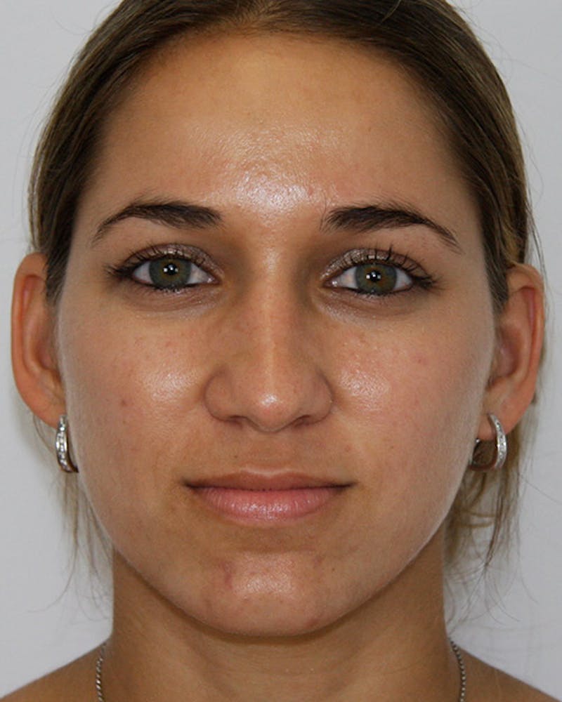 Rhinoplasty Before & After Gallery - Patient 143521972 - Image 2